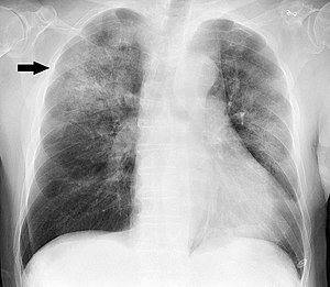 Chest radiography Pneumonia: Everything you need to know